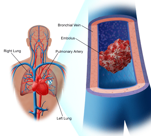 Sometimes blood clots form in the wrong location, such as within a vital 